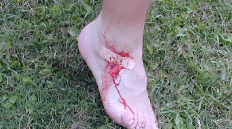 Bleeding due to a leech bite on the leg
